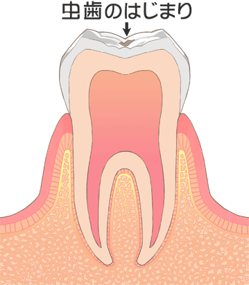 虫歯の最初期