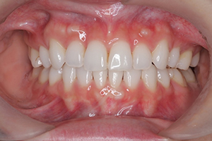 矯正歯科のケース治療後