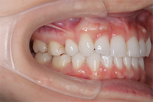 矯正歯科のケース治療後