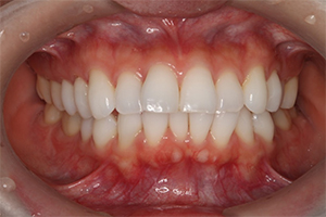 矯正歯科のケース治療前
