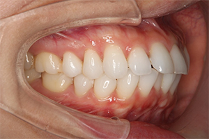 矯正歯科のケース治療前