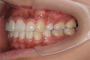矯正歯科のケース治療後