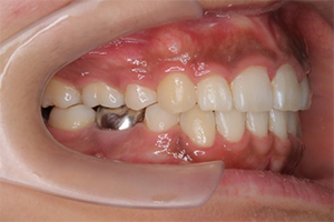 矯正歯科のケース治療後