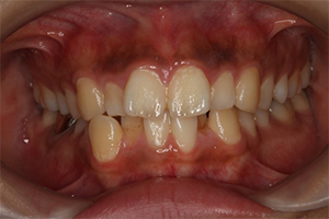 矯正歯科のケース治療前