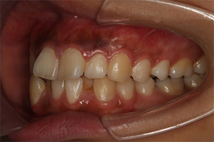 矯正歯科のケース治療前