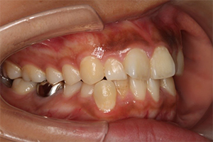 矯正歯科のケース治療前