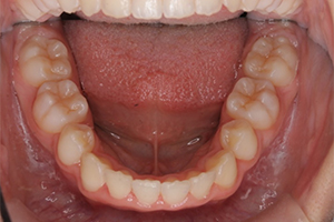 矯正歯科のケース治療後