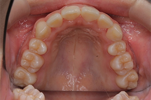 矯正歯科のケース治療後