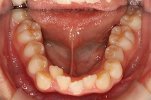 矯正歯科のケース治療前