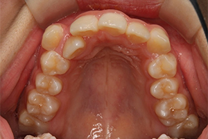 矯正歯科のケース治療前