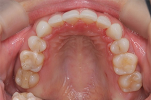 矯正歯科のケース治療後