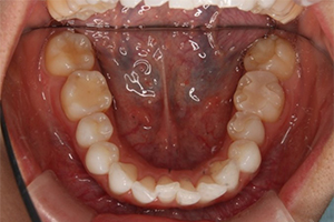 矯正歯科のケース治療前
