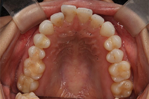 矯正歯科のケース治療前