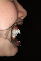 矯正歯科のケース治療前